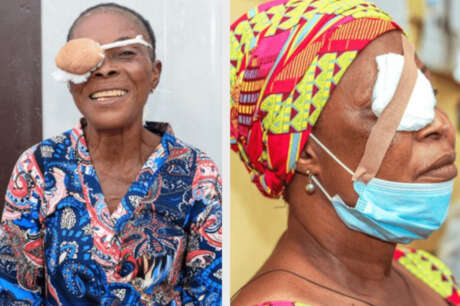 Fund Cataract Surgery for 500 Elderly Nigerians