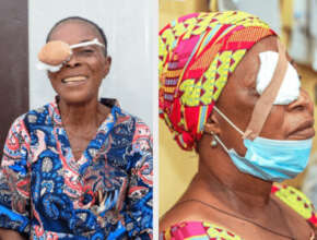 Fund Cataract Surgery for 500 Elderly Nigerians