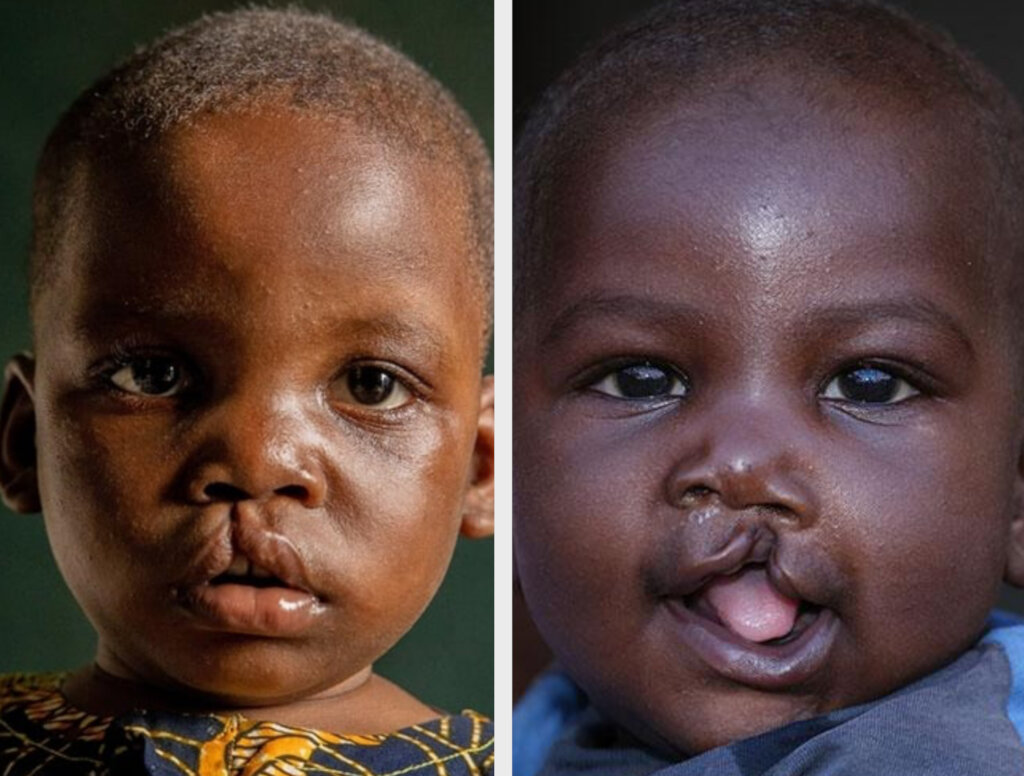 Sponsor Surgeries for 100 Children with Cleft Lips