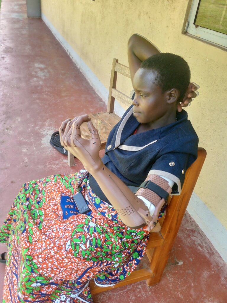 3D Print Upper Limb Prosthetics for 150 in Uganda