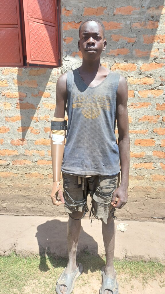 3D Print Upper Limb Prosthetics for 150 in Uganda