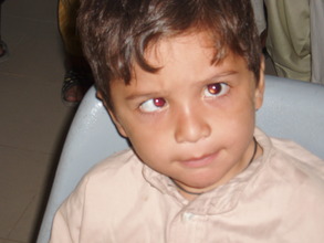 A squint child patient