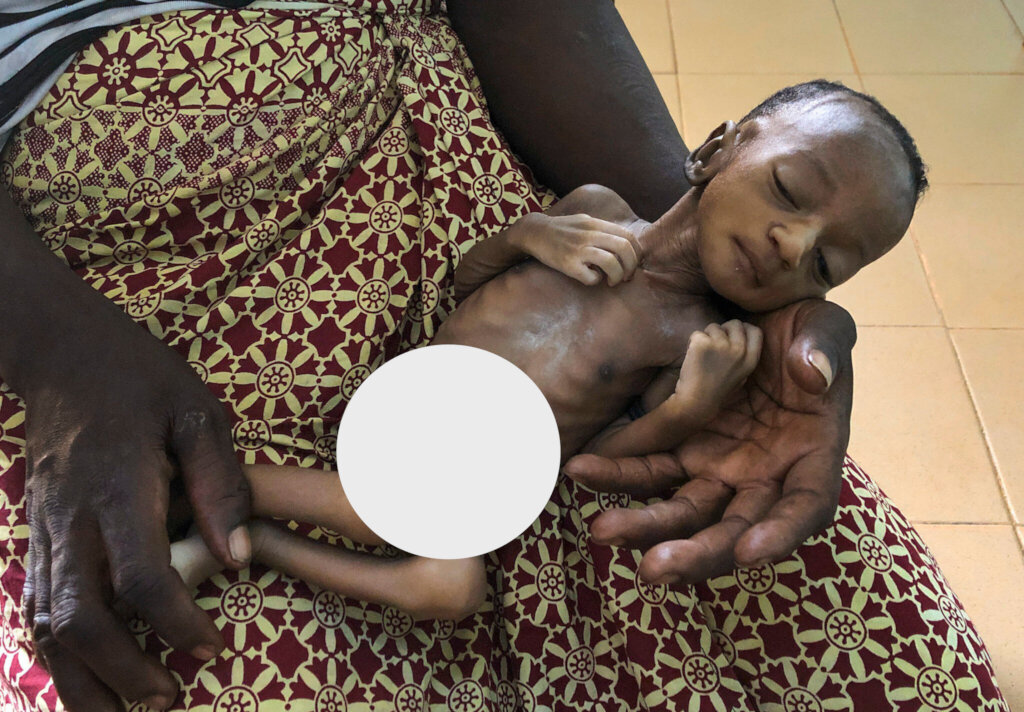 Nutrition Support for 1500 Underweight Babies
