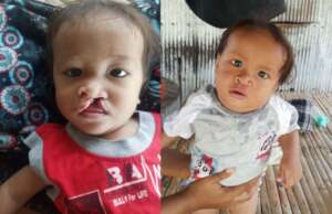 Community Mobilization - before/after surgery