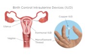 IUDs & Implants: Birth Control for 900 Rural Women