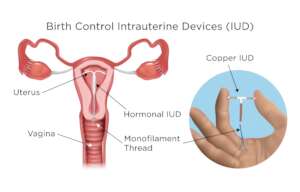 IUDs & Implants: Birth Control for 900 Rural Women