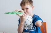 Rehabilitation of Children with amputations
