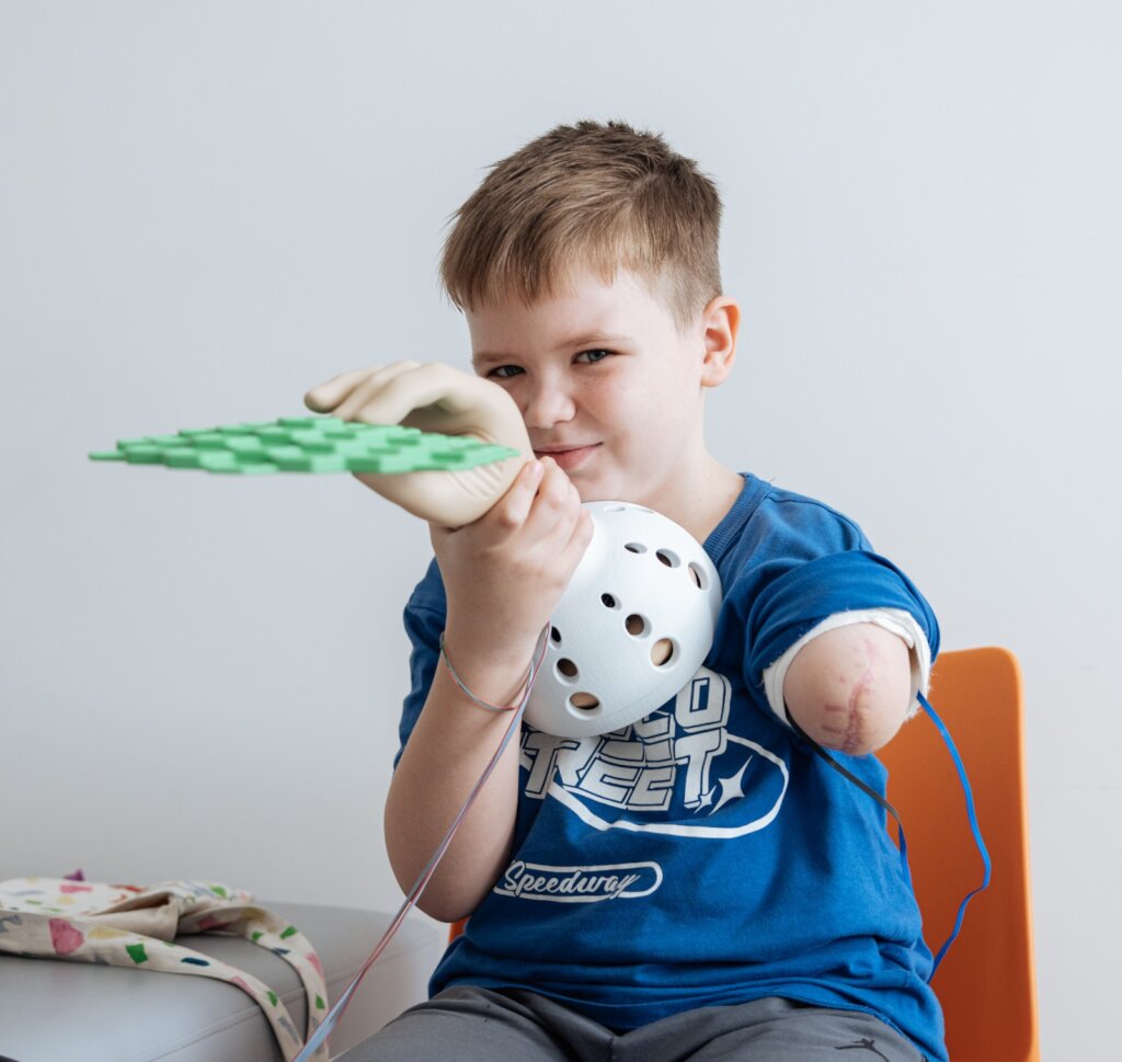 Rehabilitation of Children with amputations