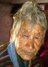 Cataract Surgery Patient