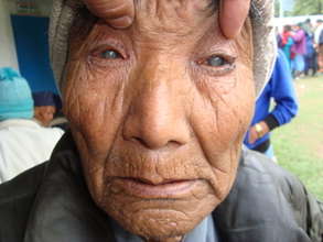 Cataract Patient