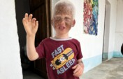 Luz - Sunscreen for Children with Albinism