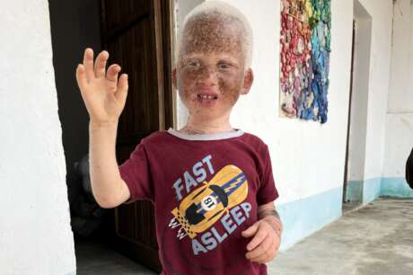 Luz - Sunscreen for Children with Albinism