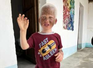 Luz - Sunscreen for Children with Albinism
