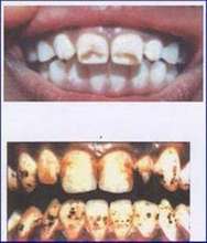 Teeth of Fluorosed children