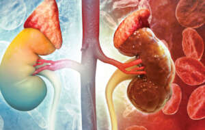 Prevention of Kidney Diseases in Nigeria