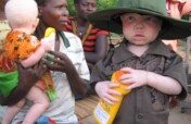 Protecting Women & Children with Albinism