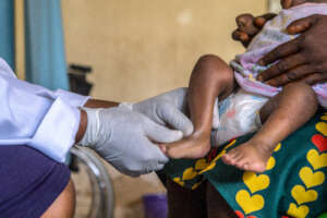 Clubfoot provider preparing to apply a cast.