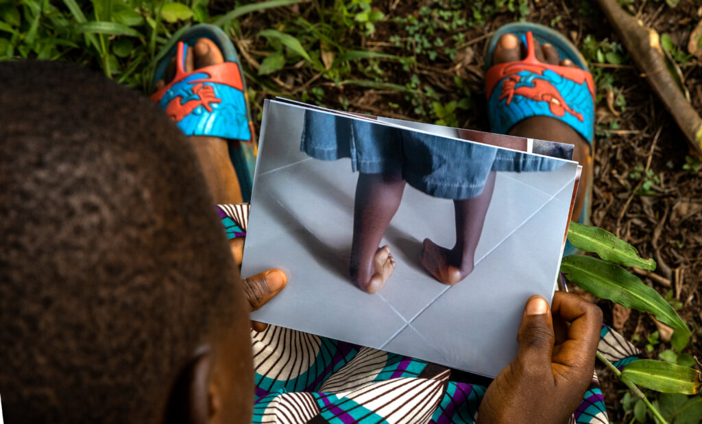 Treating clubfoot for 100 children in Nigeria