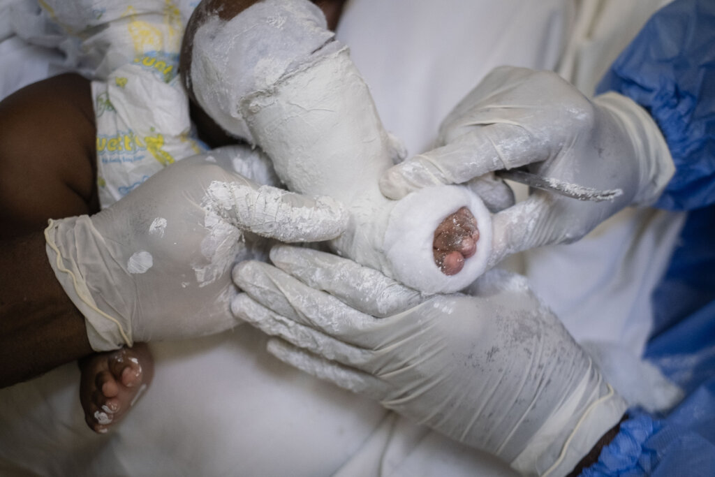 Treating clubfoot for 100 children in Nigeria