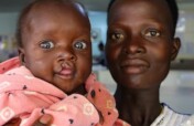 Sponsor Surgeries for 100 Children with Cleft Lips