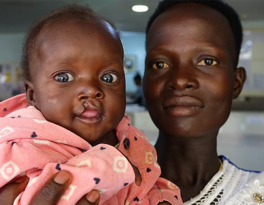 Sponsor Surgeries for 100 Children with Cleft Lips