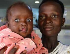 Sponsor Surgeries for 100 Children with Cleft Lips