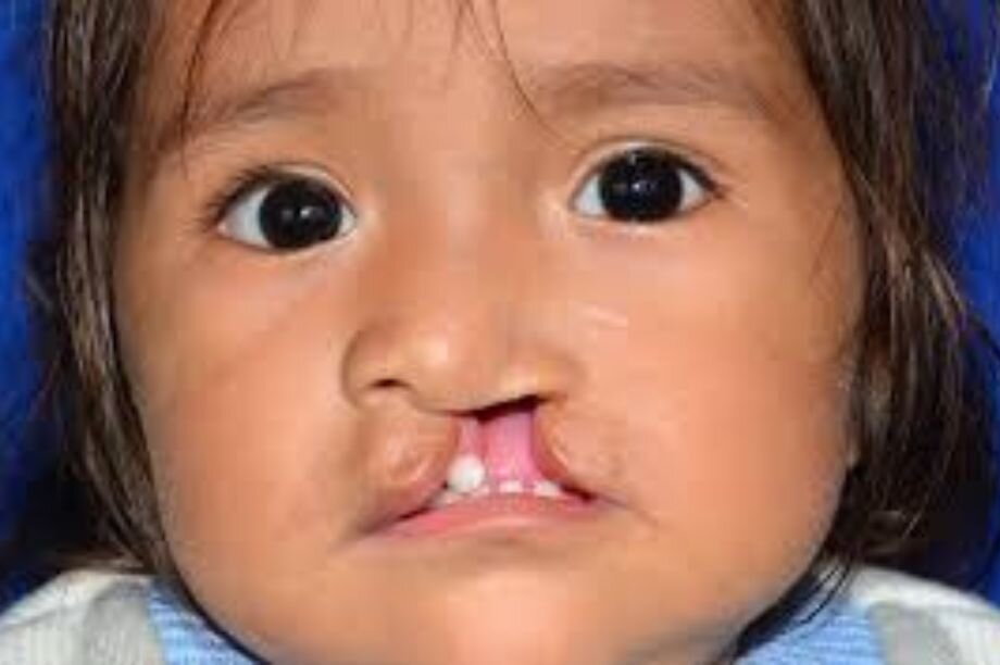 Transforming Lives: Cleft Surgery in Pakistan