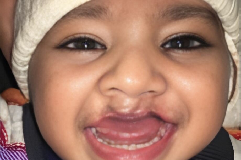 Transforming Lives: Cleft Surgery in Pakistan