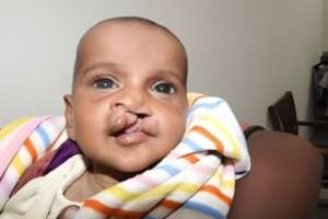 Transforming Lives: Cleft Surgery in Pakistan