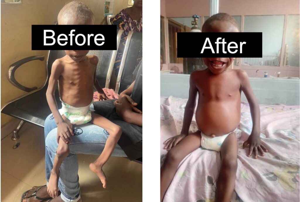 Before and After photo of a Malnourished Child