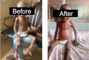 Before and After photo of a Malnourished Child