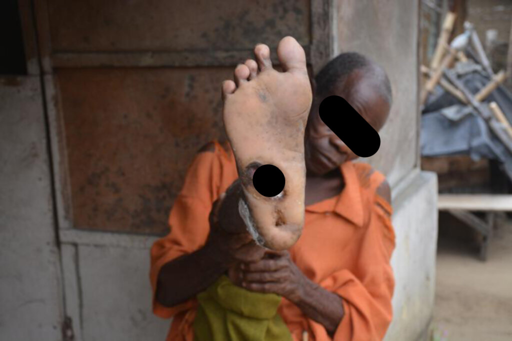 Support Treatment for People Living with Leprosy