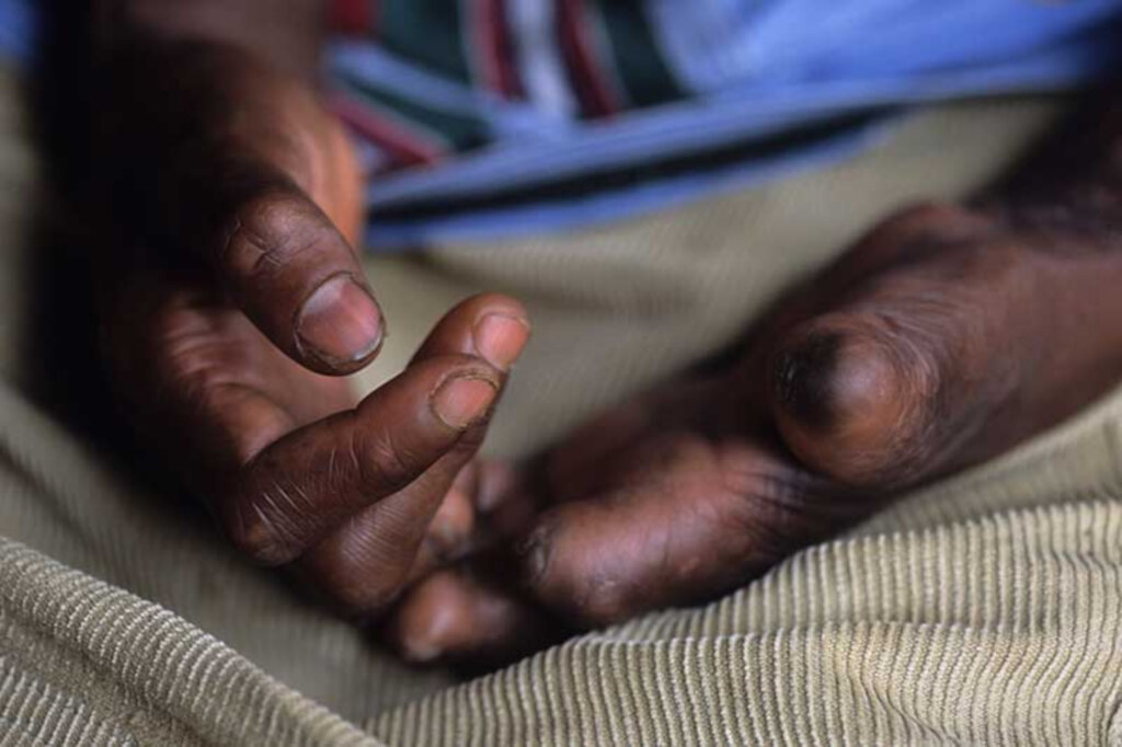 Support Treatment for People Living with Leprosy