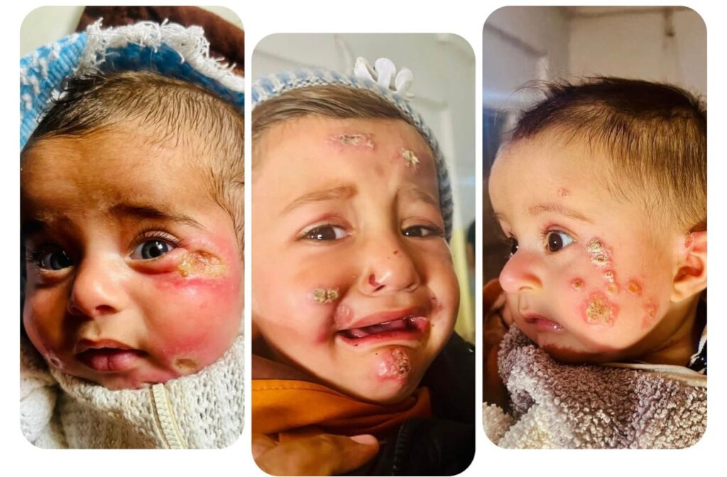 Leishmaniasis Control Project in Al-Raqqa, Syria