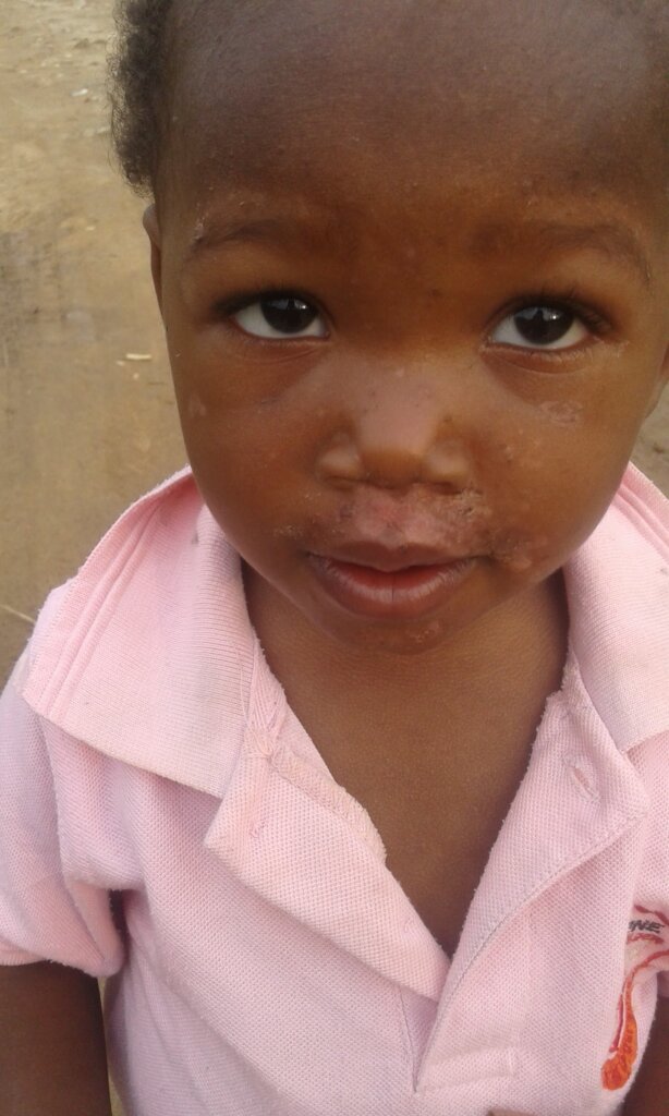 Enhanced Vaccines for Sickle Cell Kids in Nigeria