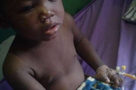Enhanced Vaccines for Sickle Cell Kids in Nigeria
