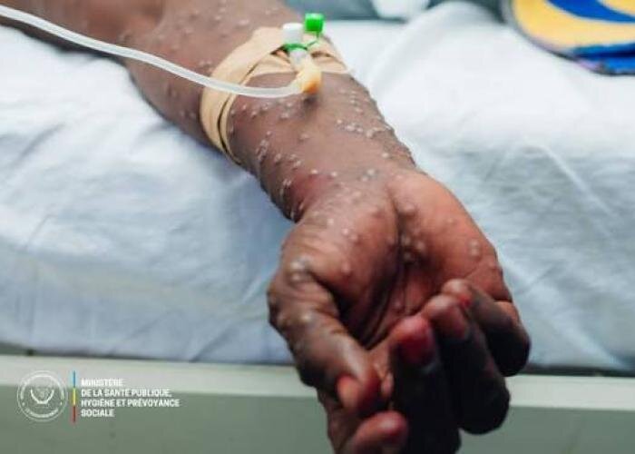 Fight DR Congo Epidemics: Ebola, Cholera, Mpox