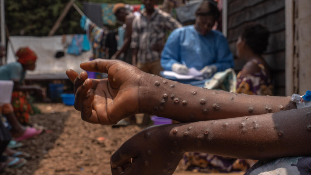 Fight DR Congo Epidemics: Ebola, Cholera, Mpox