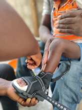 Clubfoot