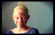Stop discrimination against children with albinism
