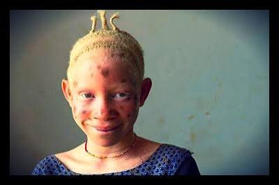Stop discrimination against children with albinism