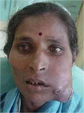 oral cancer