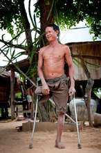 A mine victim in Cambodia