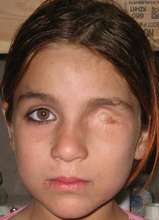 An IED blast took her eye and 3 siblings