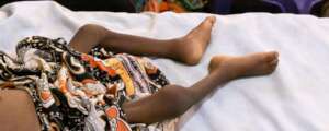 A child with severe malnutrition