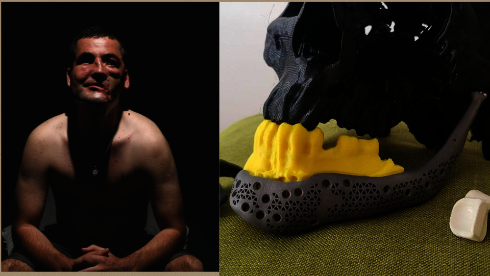 Rebuilding Faces for People Injured in the War