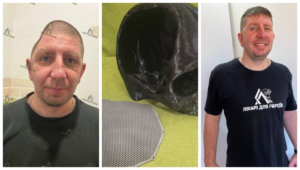 Rebuilding Faces for People Injured in the War