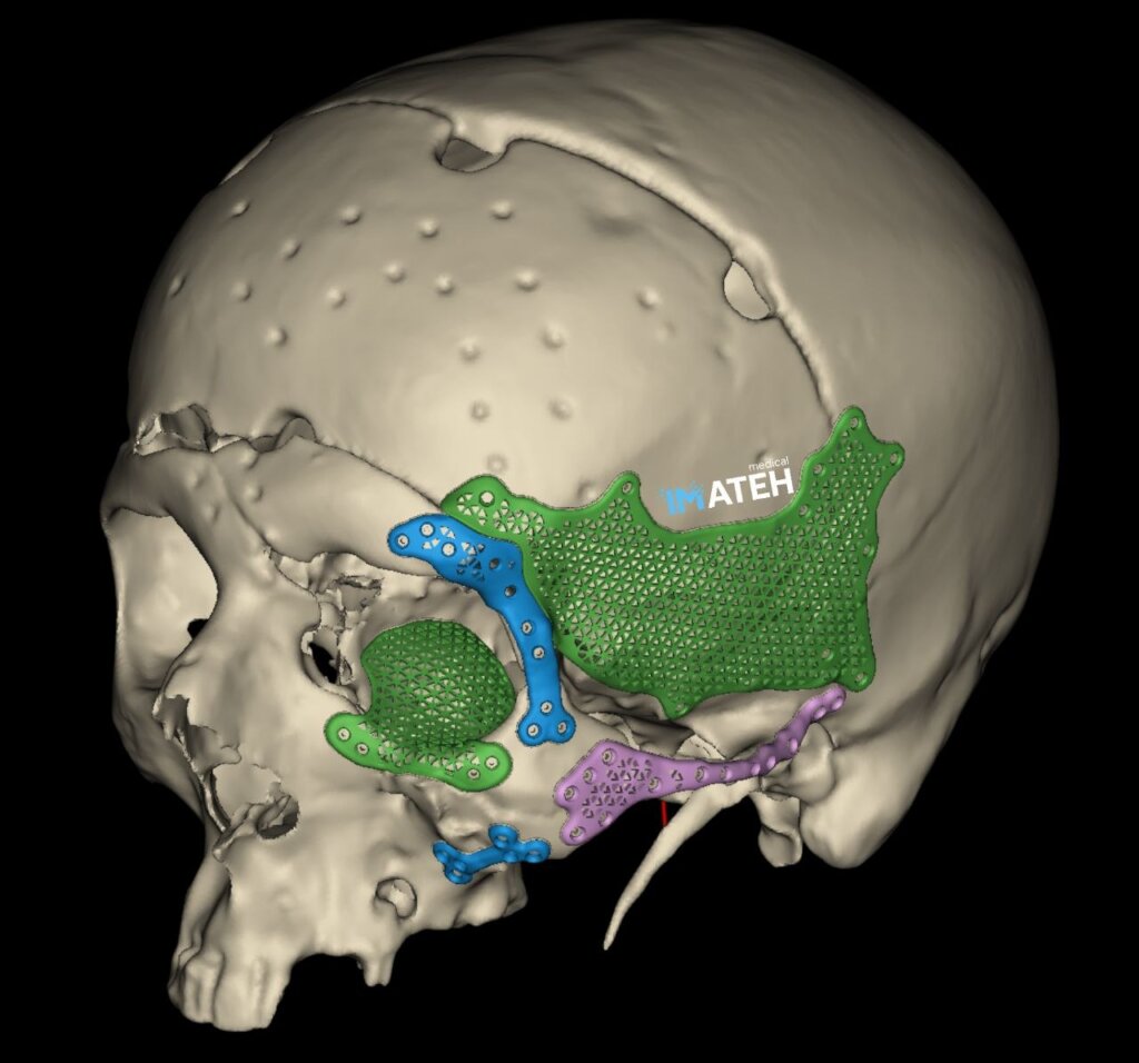 Rebuilding Faces for People Injured in the War