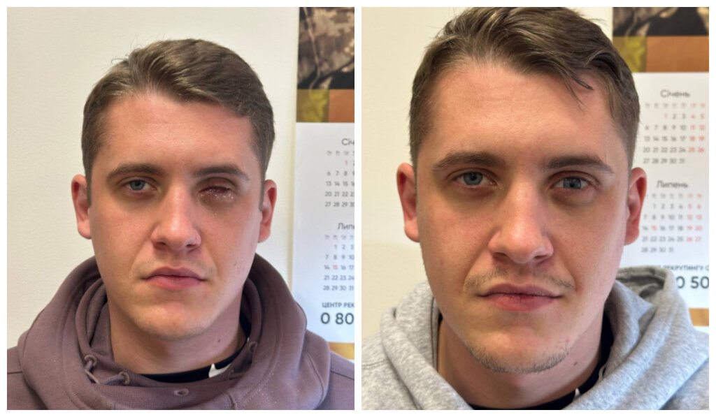Custom-made ocular prostheses