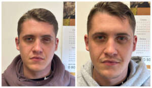 Custom-made ocular prostheses